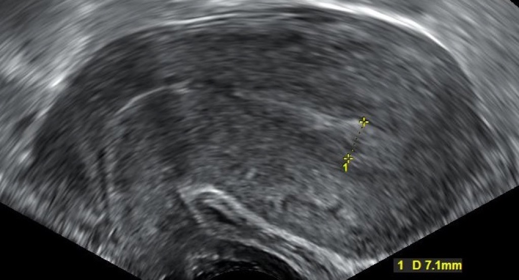 Sonogram of a complete miscarriage